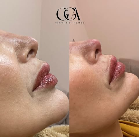 Side-by-side treatment example supplied by Gemini Glow MedSpa